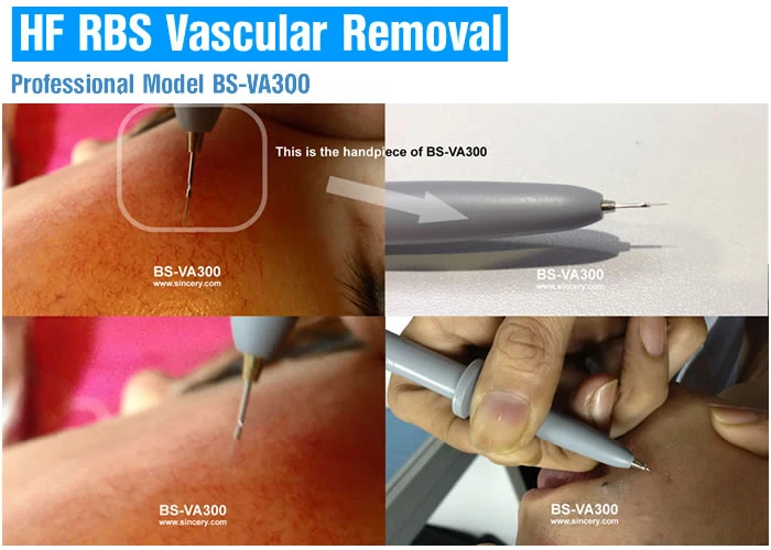 High Effective Spider Vein Vascular Removal Machine