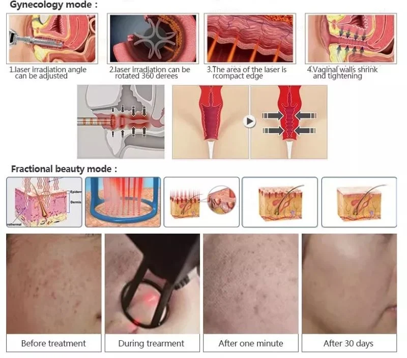 Medical Equipment Skin Resurfacing Scar Removal Vaginal Tightening Fotona 4D Fractional CO2 Laser