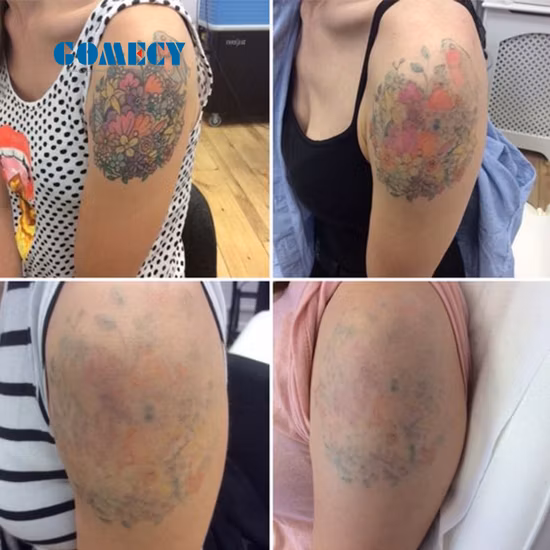 Portable picoseconde ND YAG Laser détatouage Peeling au carbone