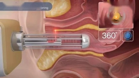 Tube RF en métal Élimination des vergetures Resserrement vaginal Laser CO2 fractionné Laser CO2 fractionné Resserrement vaginal Rajeunissement de la peau Laser CO2 fractionné